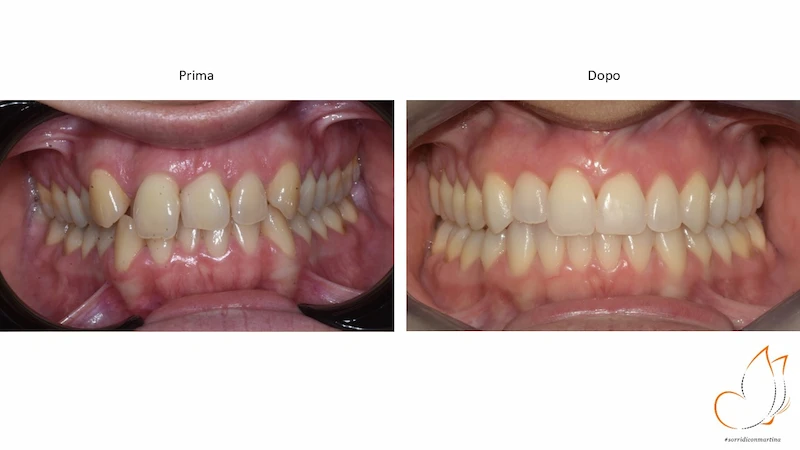 Caso prima e dopo: Denti accavallati